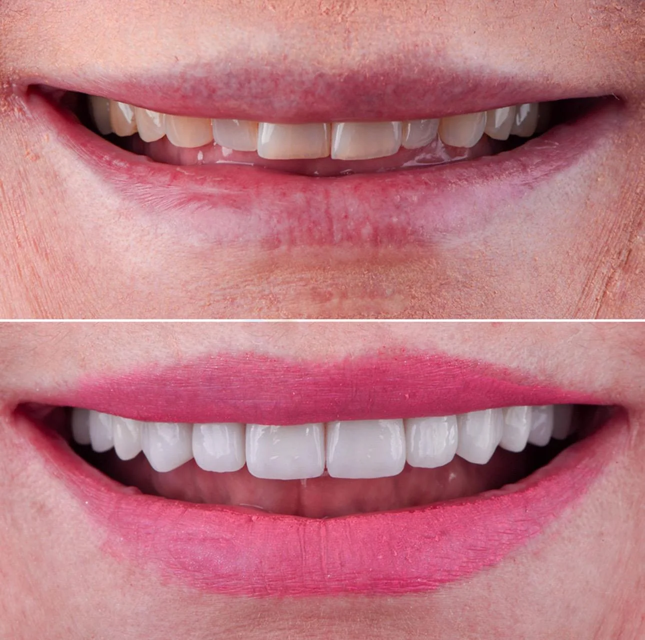 Estetică dentară cu fațete ceramice, înainte și după